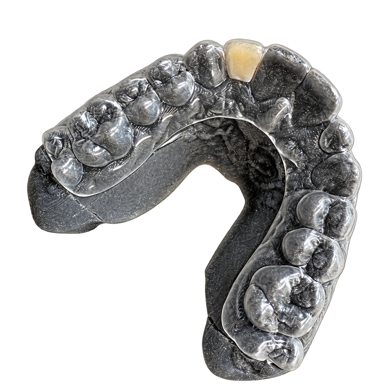 Essix retainer with bonded pontic fabricated by Retainer Express
